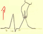 Hyperkaliémie