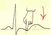 Hypokaliémie